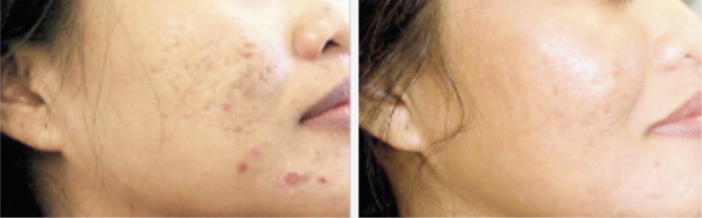 female patient's before and after results after sciton treatment